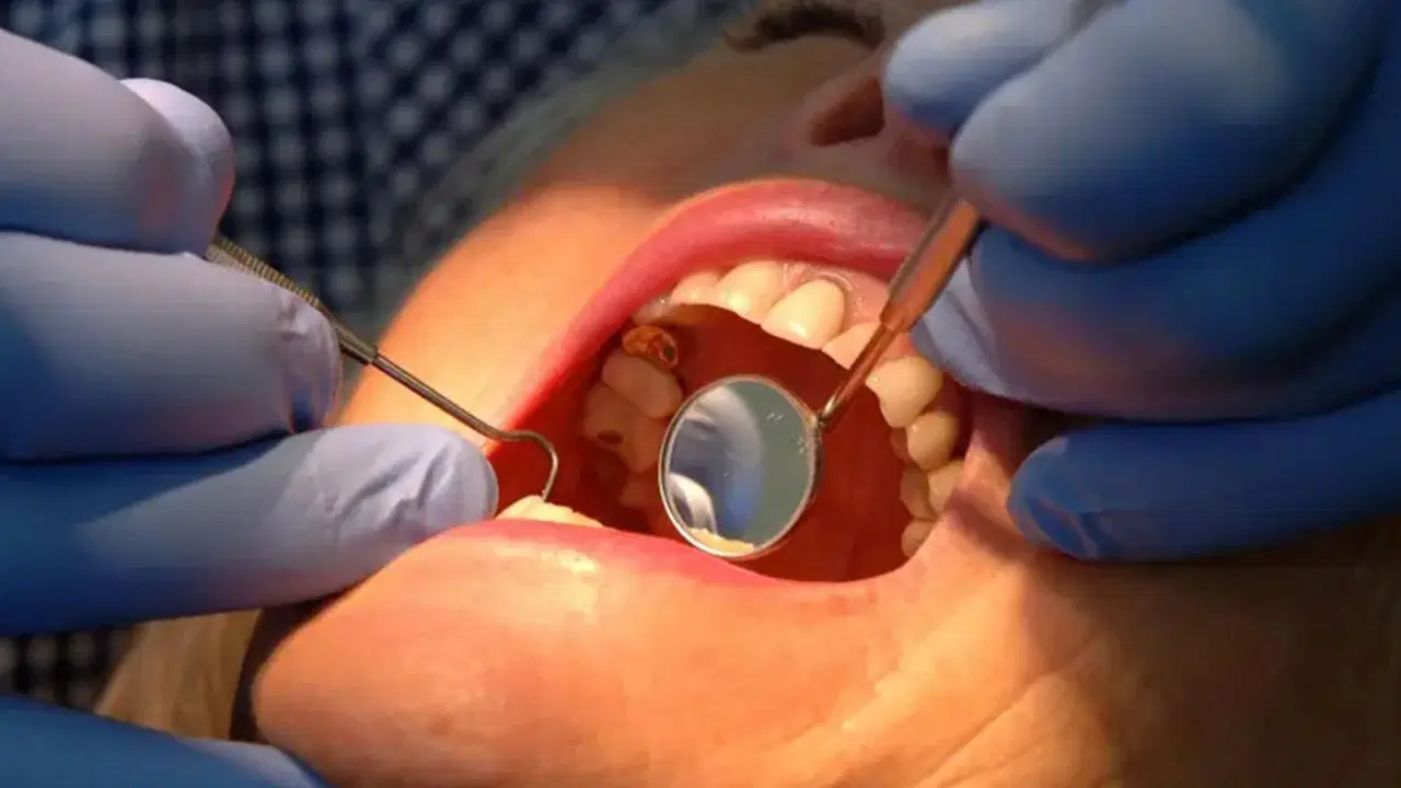 dis minesini onaran yeni jel curuklerin sonu mu geliyor naE27ErQ.jpg